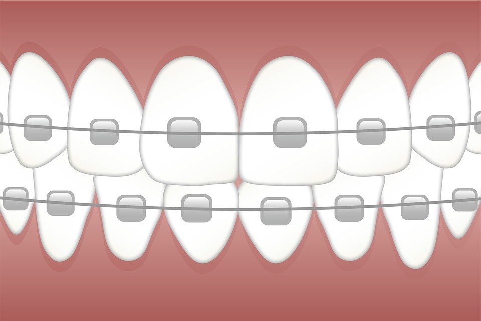 Dental-Braces-In-Hadapsar