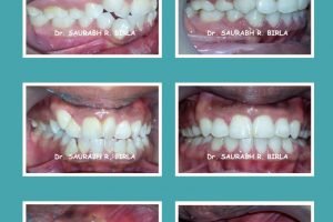 Before After Dental treatment